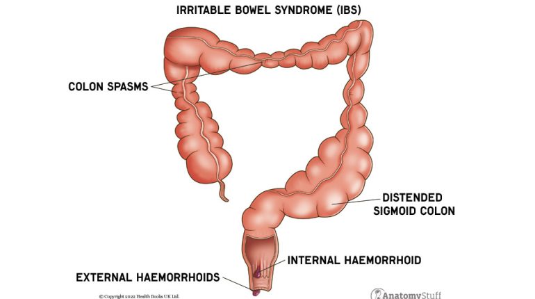Managing Irritable Bowel Syndrome (IBS): Tips for a Healthier Digestive Life